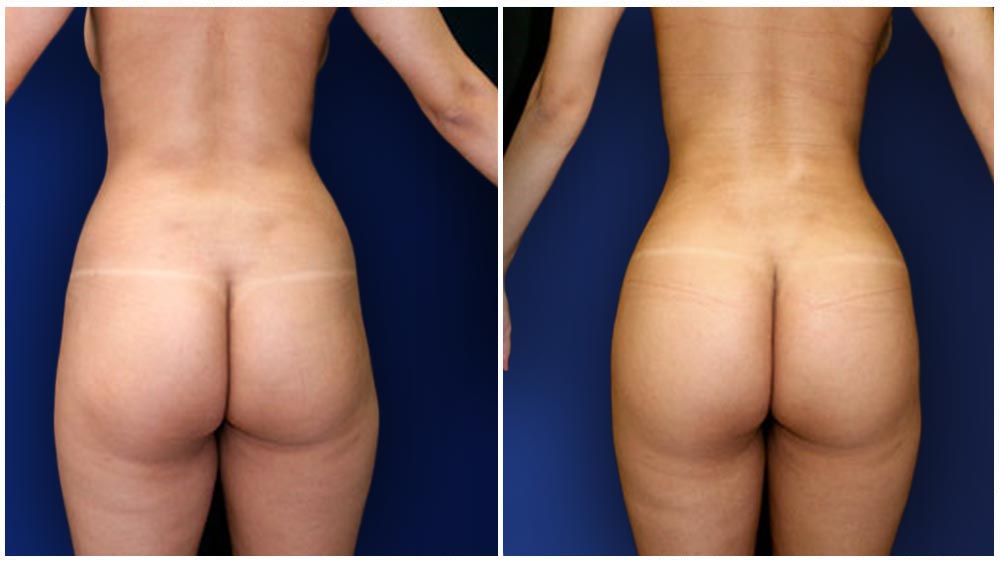 Waist and legs reshaping using Lipo360